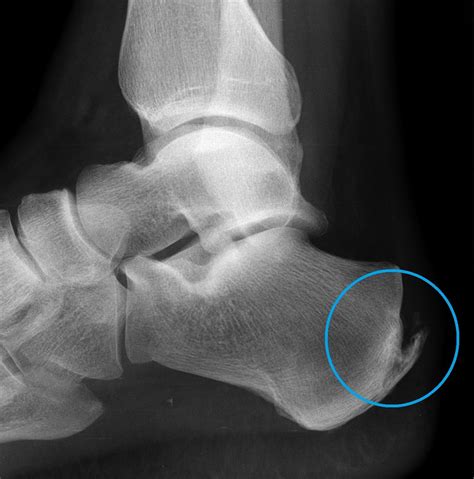 Heel Spurs | Dr Ben Beamond | Adelaide
