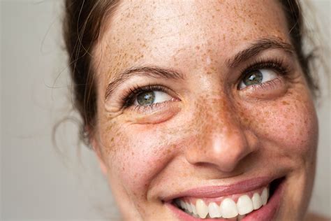 Freckles Concerns - Exeter - Skin Southwest