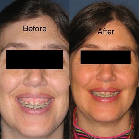 Orthognathic Surgery Open Bite Before And After at Herbert Hamilton blog