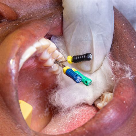 Root Canal Infection 6 Signs Of Root Canal Infection Premiere Dental