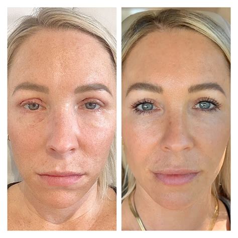 Sylfirm X — EverGlow Aesthetics