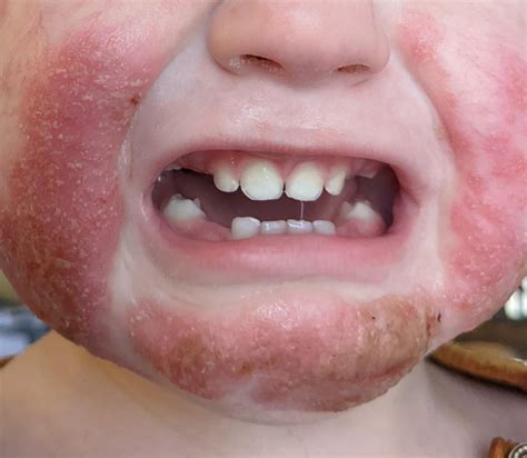 A desperate mom looking for help. : r/eczema