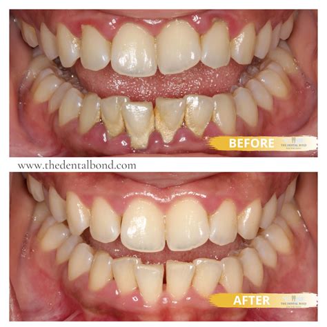 Natural remedies to reverse receding gum line without surgery – Artofit