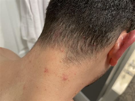 Bumps On Back