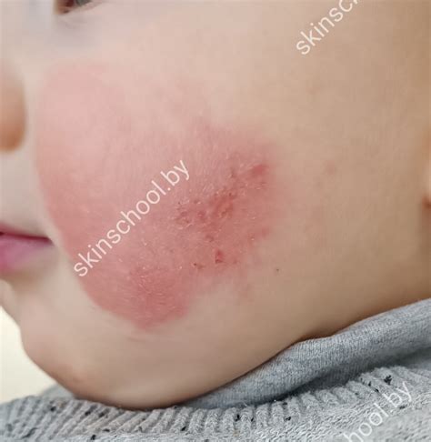 Атопический дерматит на лице (фото заболевания в конце) | Советы ...
