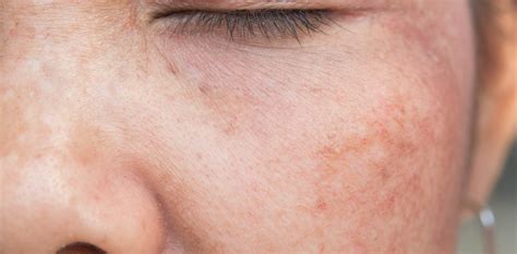 Hyperpigmentation Treatments | Santa Barbara | TMA