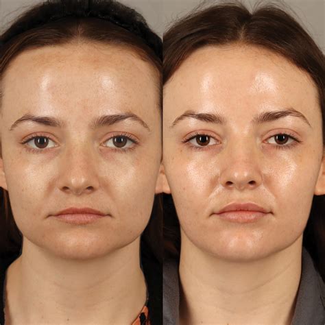 Non-Surgical Facial Slimming - CabinMD Facial Plastics & Aesthetics
