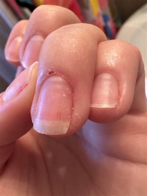 Does anyone know what these little red lines are ? I knooowwwww my ...