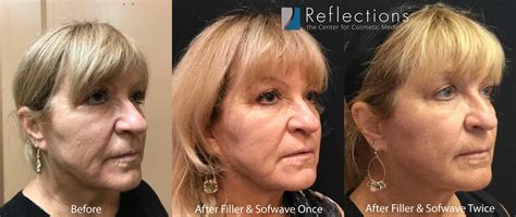 Sofwave & Filler Non-Surgical Facelift for 65 Year-Old Woman Before ...