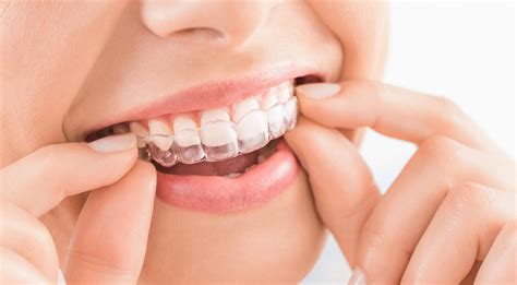 Invisalign Treatment in Kochi - Clear Aligners - Dental Point