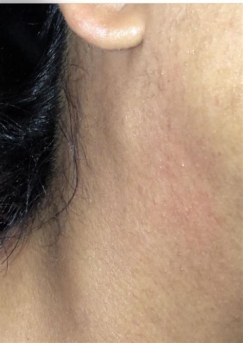 Painful lump under my right earlobe area and back of jaw area. : r/DiagnoseMe