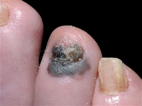 Reconstruction after wide excision of primary cutaneous melanomas: part ...