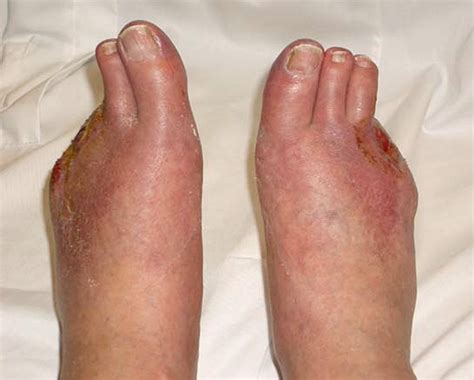 Purple Toe Syndrome - EJVES Extra