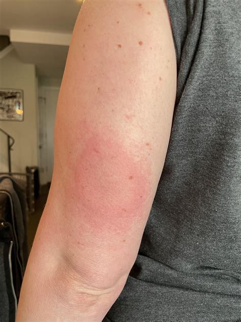 Anyone ever have a allergy shot reaction that took over their whole arm ...