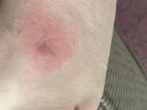 Irritant contact dermatitis? Stitches removed for mole removal 11/24 ...