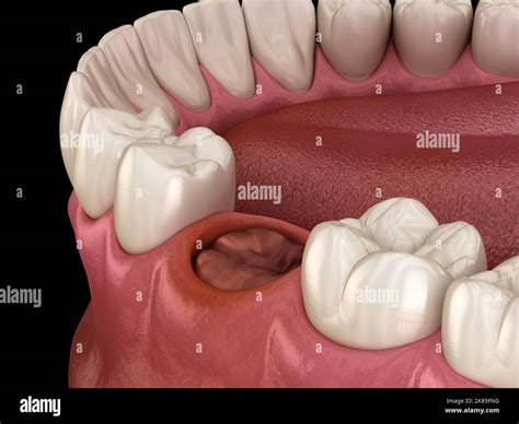 The blood clot seals off the tooth after extraction. Medically accurate 3D illustration Stock ...