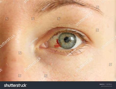 Bloodshot Eye Woman Burst Blood Vessel Stock Photo (Edit Now) 1138298924