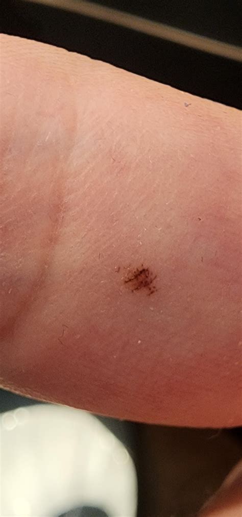 Is it Acral Lentiginous Melanoma or something? Very small dot on finger. About month old : r ...