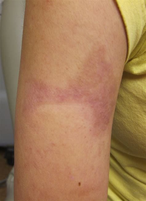 Laser Skin Treatment For Burn Scars at Phyllis Fetter blog