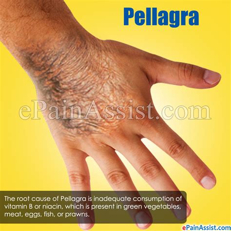 Is Pellagra An Autoimmune Disease - Captions Tempo