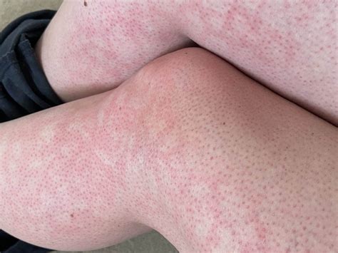 Infant Mottling Skin