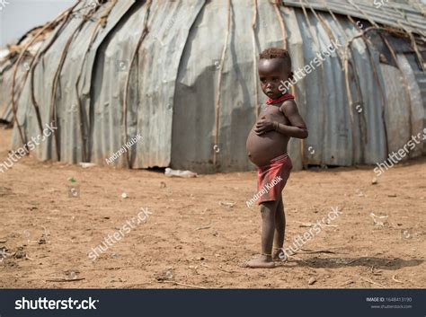 Bloated Stomach African Children