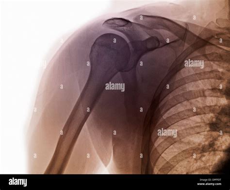normal shoulder x-ray Stock Photo - Alamy
