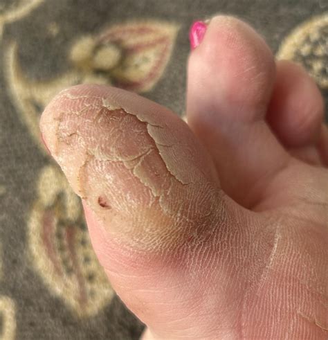 Both big toes calluses are cracked and won’t stop peeling : r ...