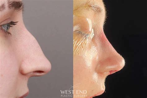 Rhinoplasty & Septoplasty (Immediately After) Before & After Gallery - Case: 10670