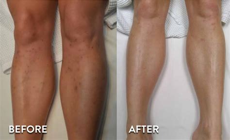 Laser Hair Removal Before And After Legs Best Laser Hair Removal