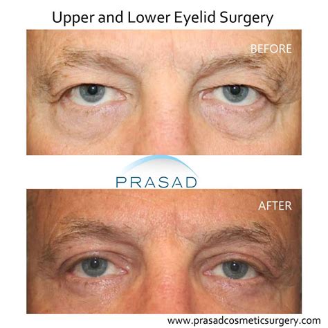 Saggy Upper Eyelid/Hooded Eyelids Help – ELXJC