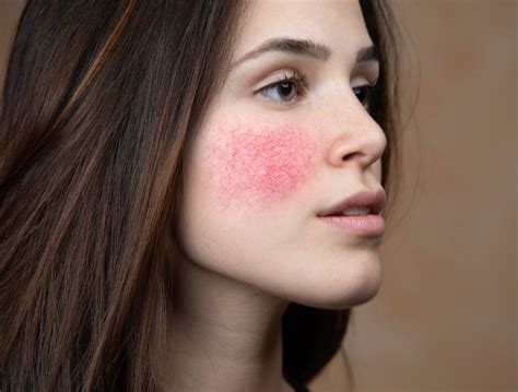 MS Rash on Face: Causes, Symptoms, and Treatments for Multiple ...