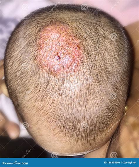 Treated Tinea Capitis or Fungal Infection on Scalp of Southeast Asian, Burmese Two Years Old ...