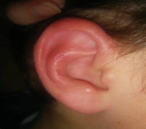 Red Ear Syndrome in a Pediatric Patient : Pediatric Emergency Care