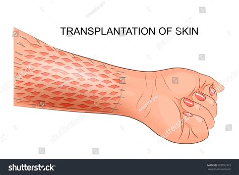 Layers Of Skin Graft at Christian Corlette blog
