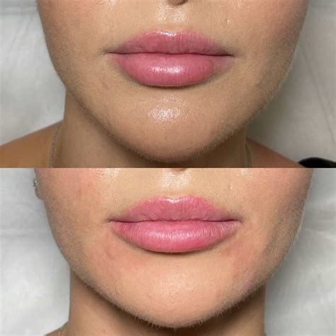 What Happens If You Dissolve Lip Fillers? | London & Surrey Guide - It ...