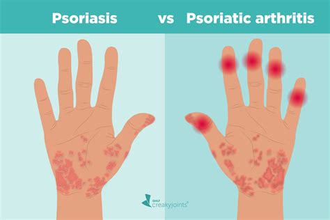 Psoriasis and Psoriatic Arthritis: What's the Connection?