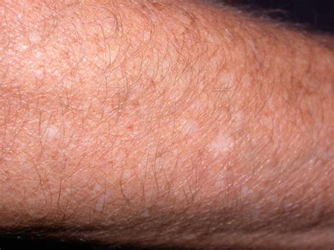White Rash on Skin: Fungus, Sun, and More