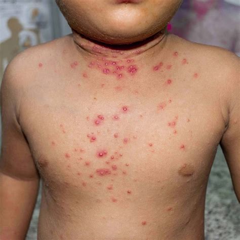 Molluscum contagiosum - Plasma+