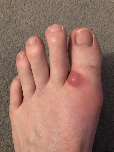 Foot Lumps Images at Christopher Sachs blog
