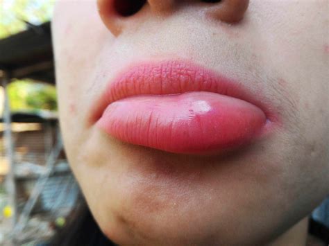 Bee Sting Face Swelling