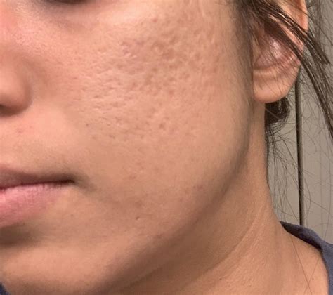 how do i get rid of an irritation bump on nostril piercing??!!! 2 ...