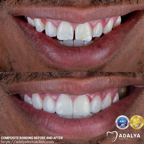 Composite Bonding Before and After: Real UK & US Patients