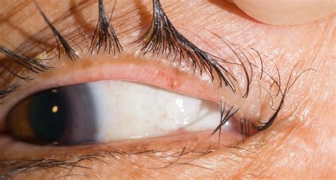 Trichiasis Treatment Trachoma | Nature Reviews Disease Primers