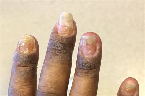 Chronic Paronychia Home Treatment