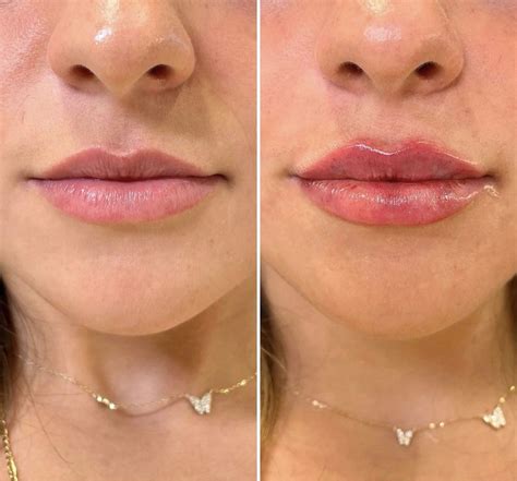 @injectorgabrielle | Lip fillers, Botox lips, Facial fillers
