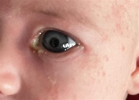 Infected Tear Duct Images Blocked Tear Ducts In Infants (Pediatric