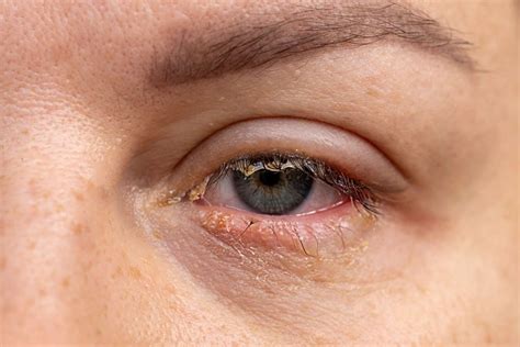 8 Causes of Crusty Eyes and How To Treat Them
