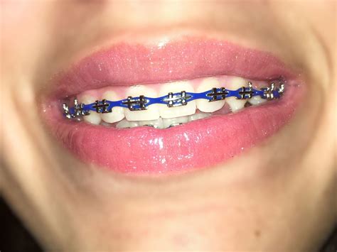Blue braces | Braces colors, Dark blue braces, Teeth braces