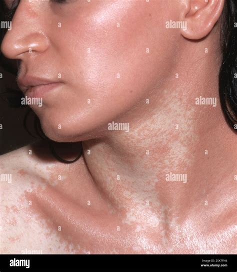 Pityriasis rubra pilaris on the neck of a 25 year old patient ...